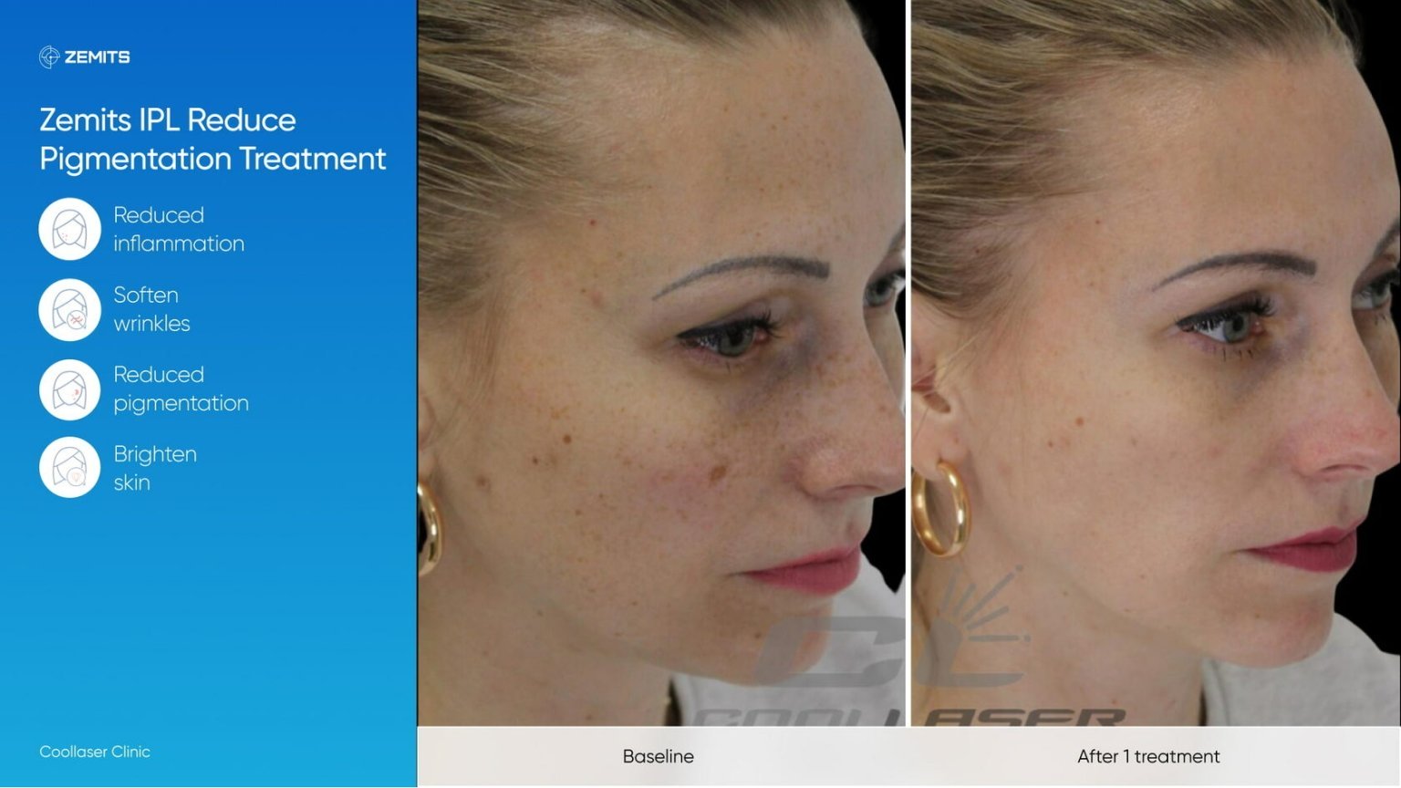 Zemits_real_results_1403.jpg My default image