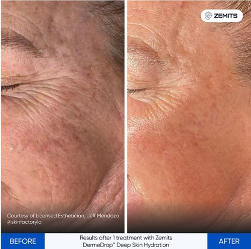 Results after 1 treatment with Zemits DermeDrop™ Deep Skin Hydration.jpg My default image