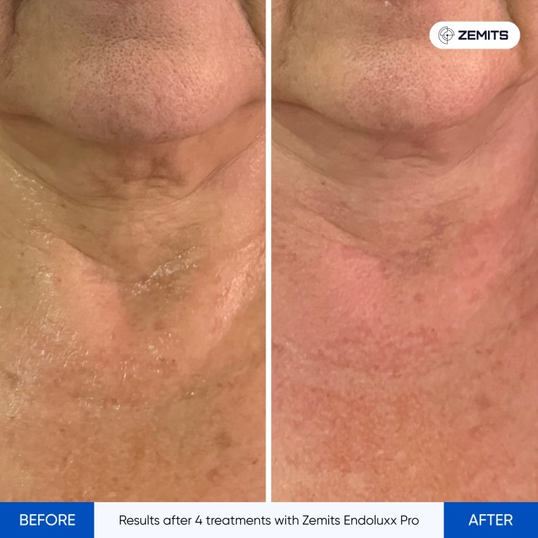 Results after 4 treatments with Zemits Endoluxx Pro.jpg My default image