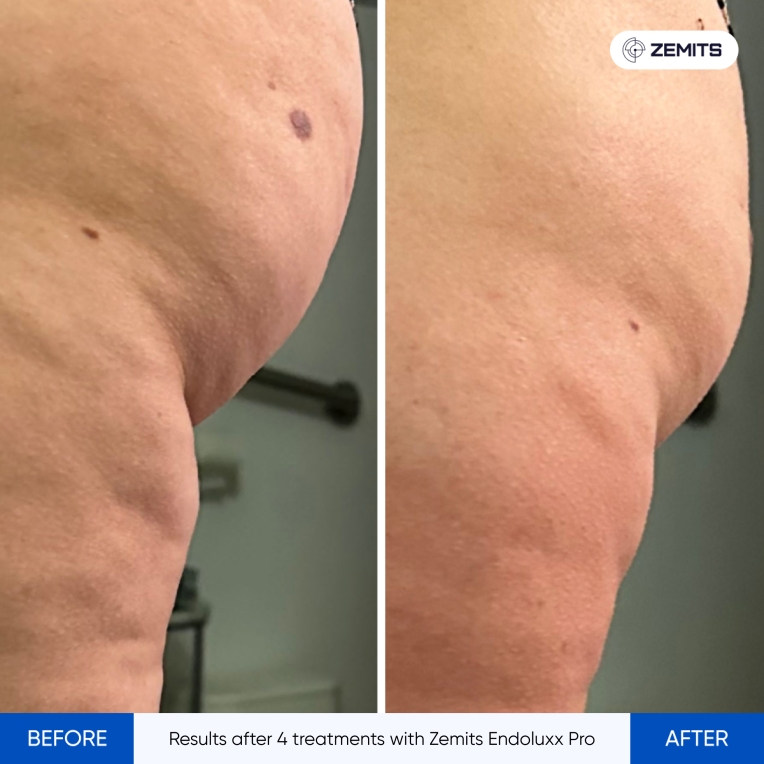 Results after 4 treatments with Zemits Endoluxx Pro-1.jpg My default image