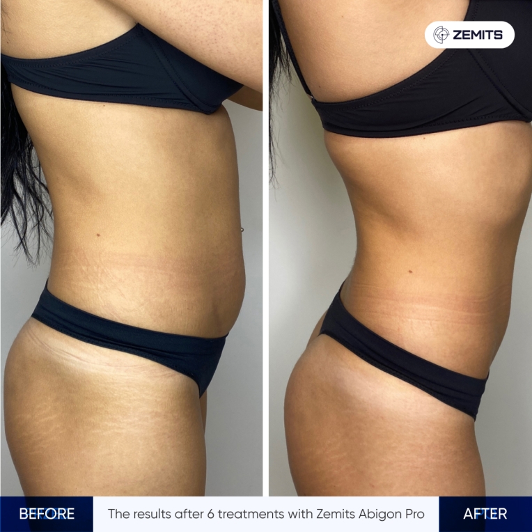 Zemits Abigon Pro.jpg My default image