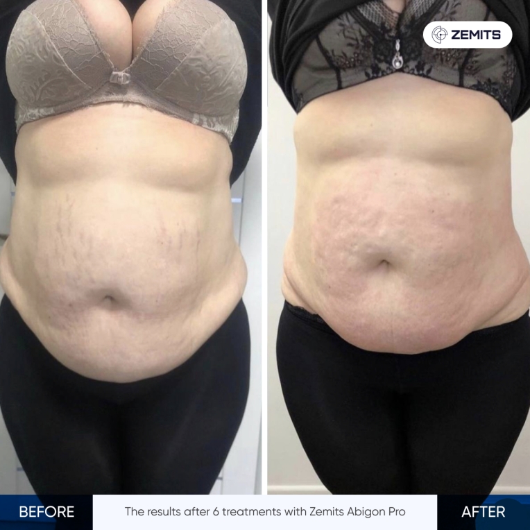 Zemits Abigon Pro(1).jpg My default image