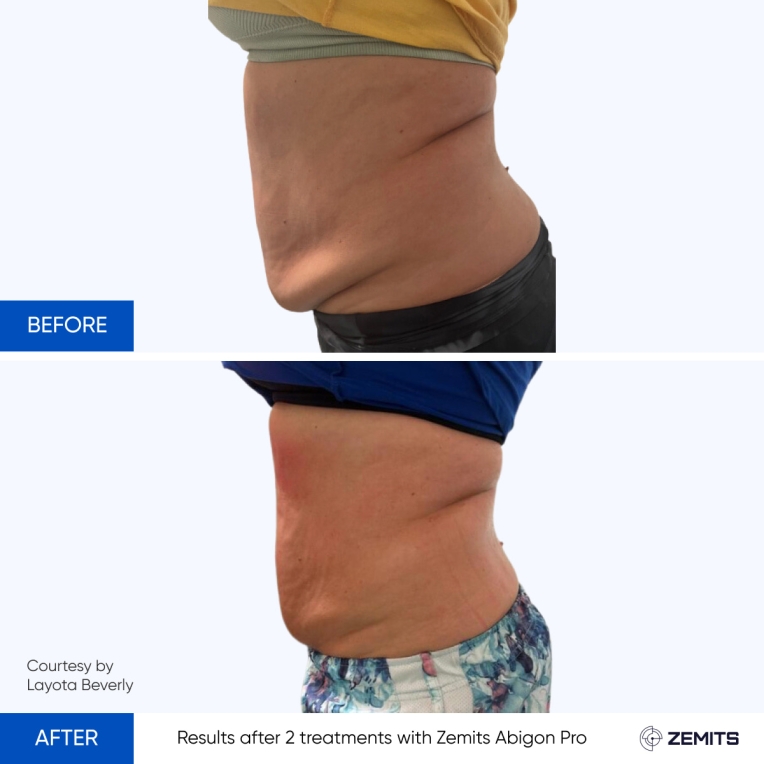 Results after 2 treatments with Zemits Abigon Pro.jpg My default image