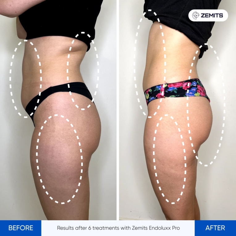 Results after 6 treatments with Zemits Endoluxx Pro.jpg My default image