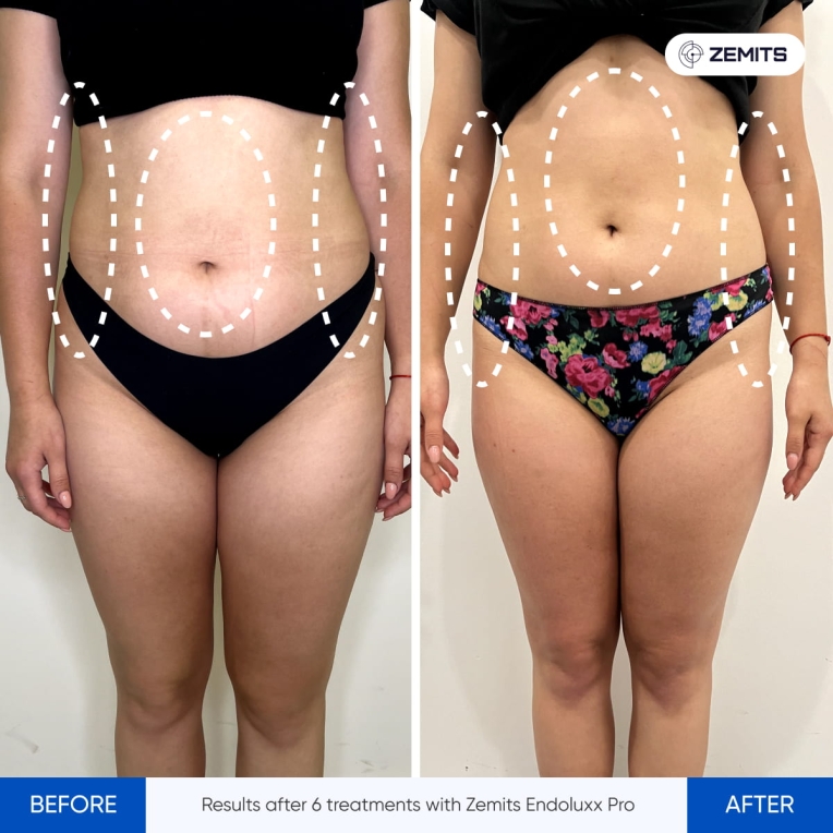 Results after 6 treatments with Zemits Endoluxx Pro-1.jpg My default image