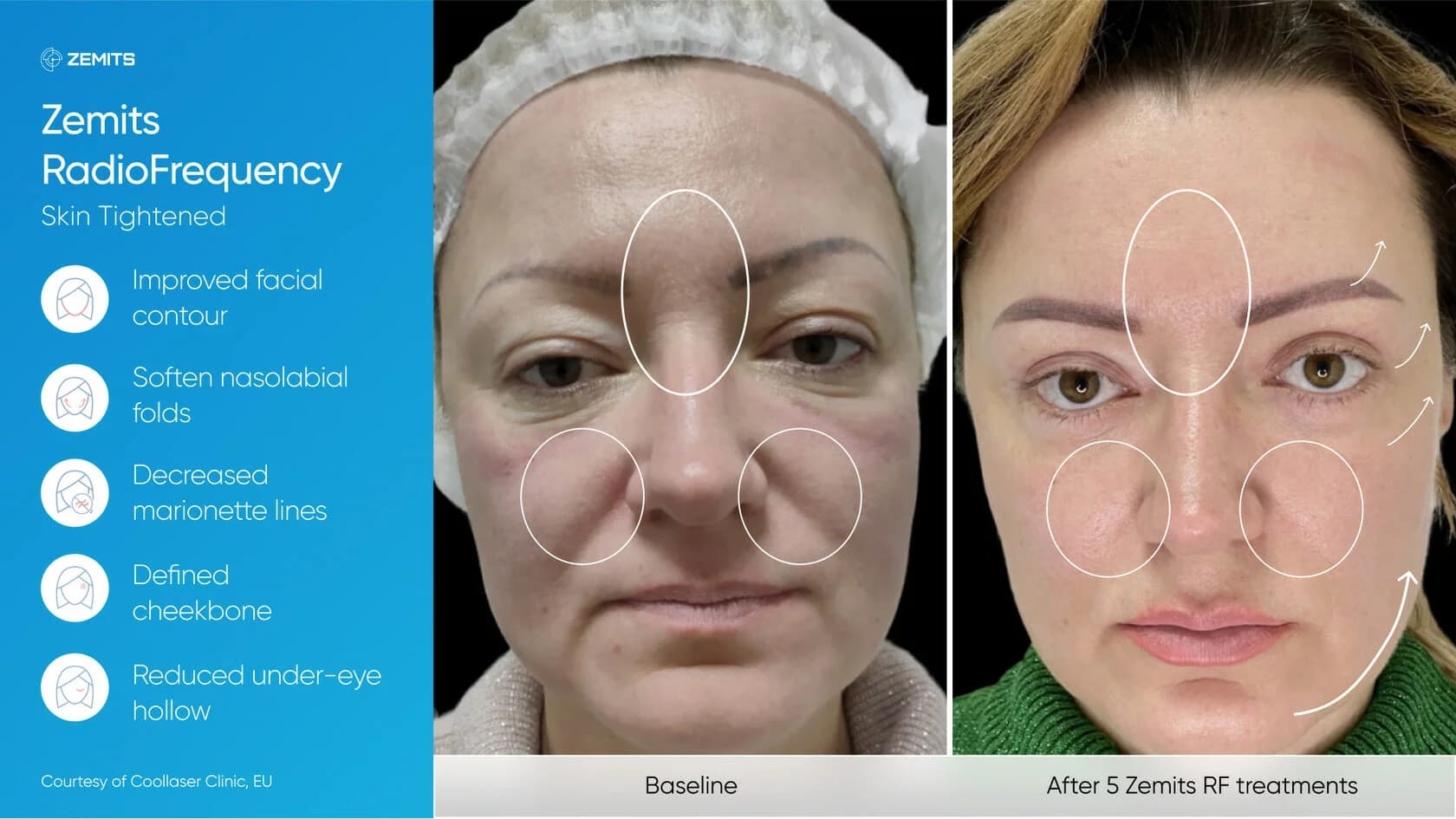 Zemits_real_results_002.jpg My default image