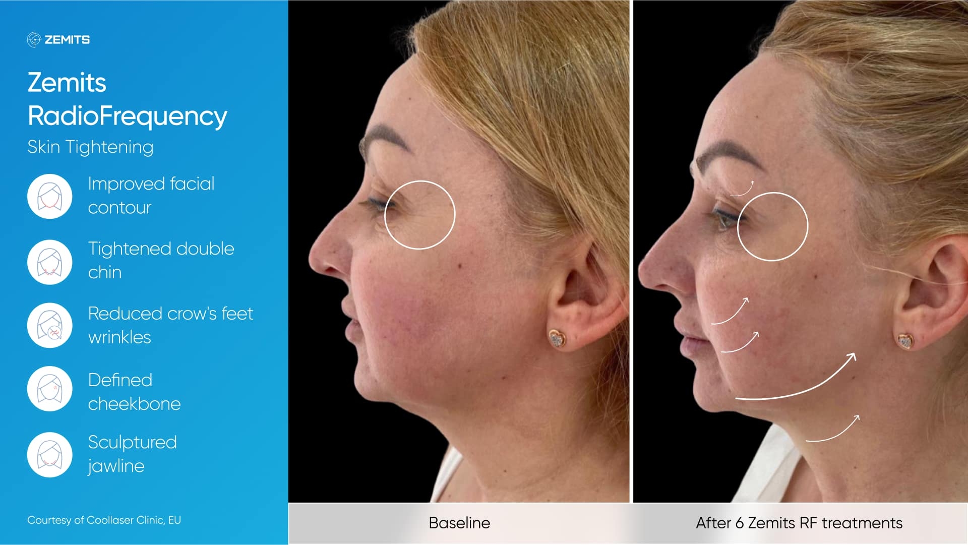 Zemits_real_results_003.jpg My default image