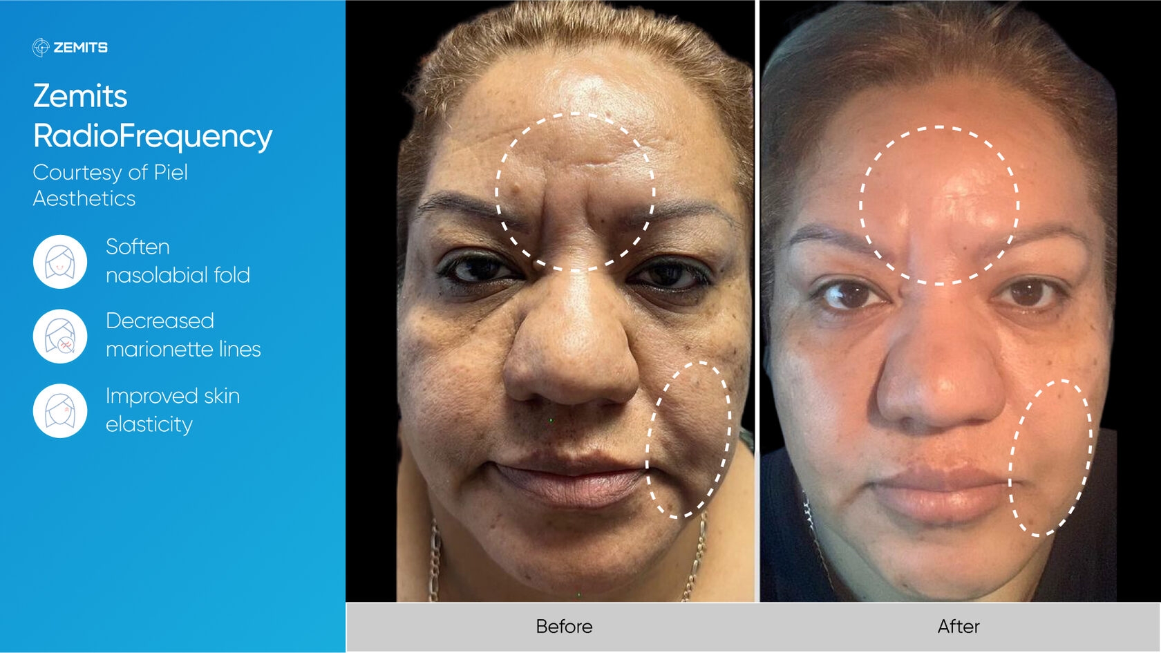 Zemits_real_results_004.jpg My default image