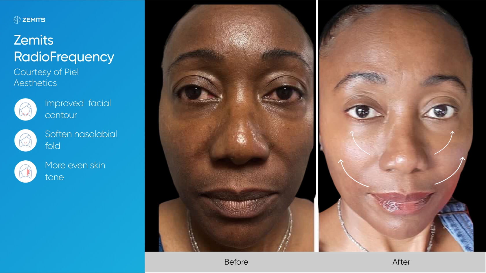 Zemits_real_results_005.jpg My default image