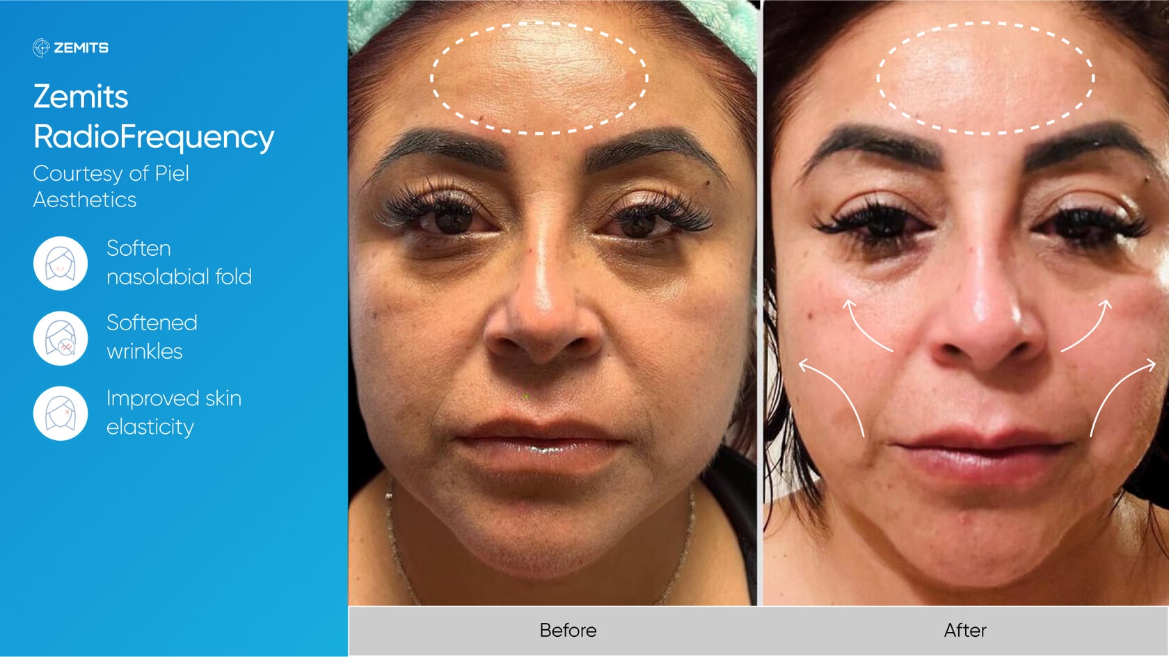 Zemits_real_results_006.jpg My default image