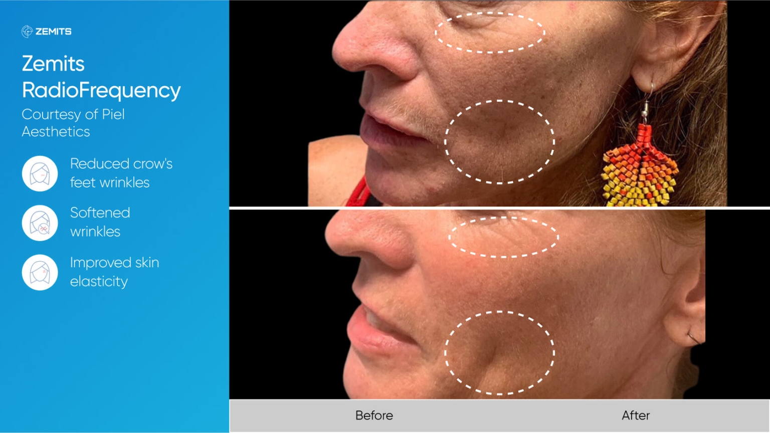 Zemits_real_results_007.jpg My default image