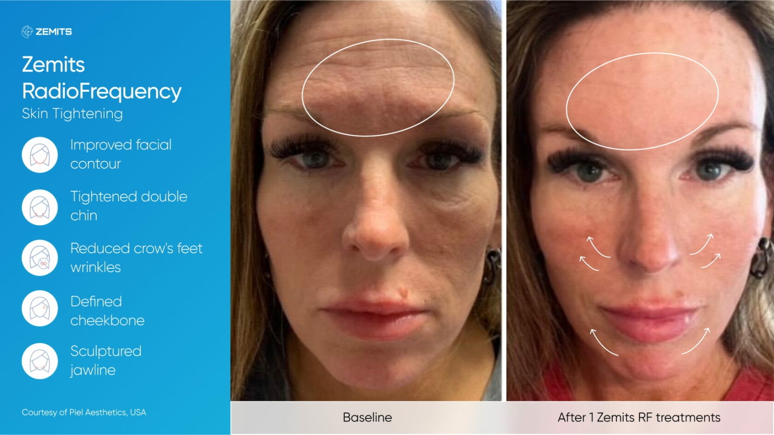 Zemits_real_results_008.jpg My default image