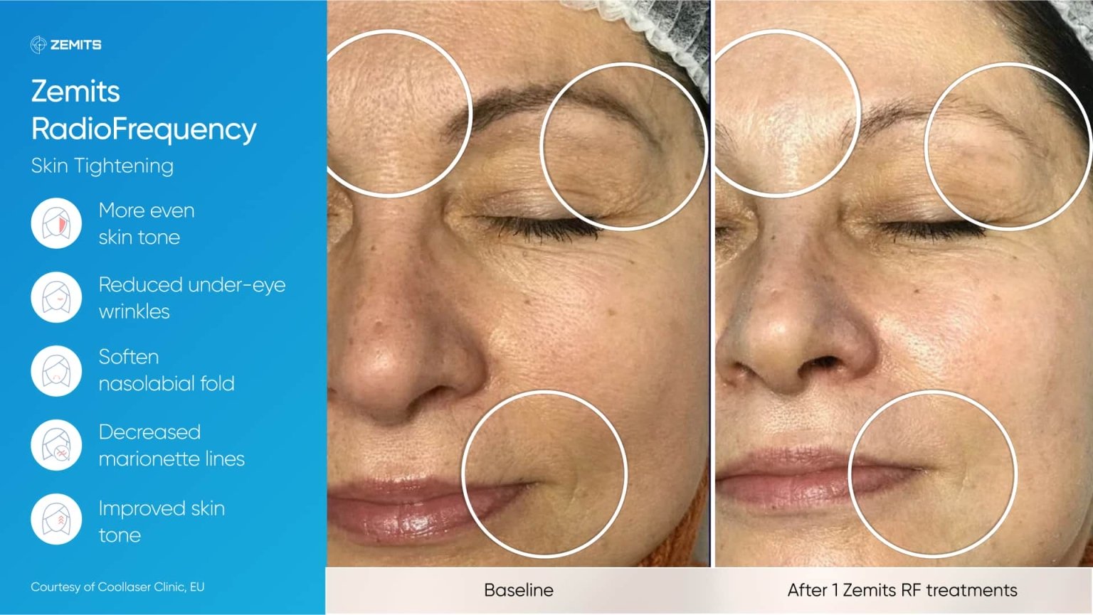 Zemits_real_results_009.jpg My default image