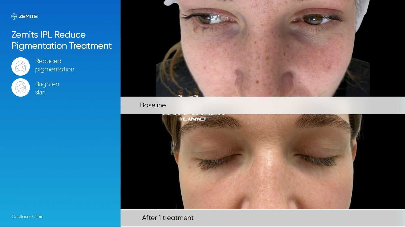 Zemits_real_results_1401.jpg My default image