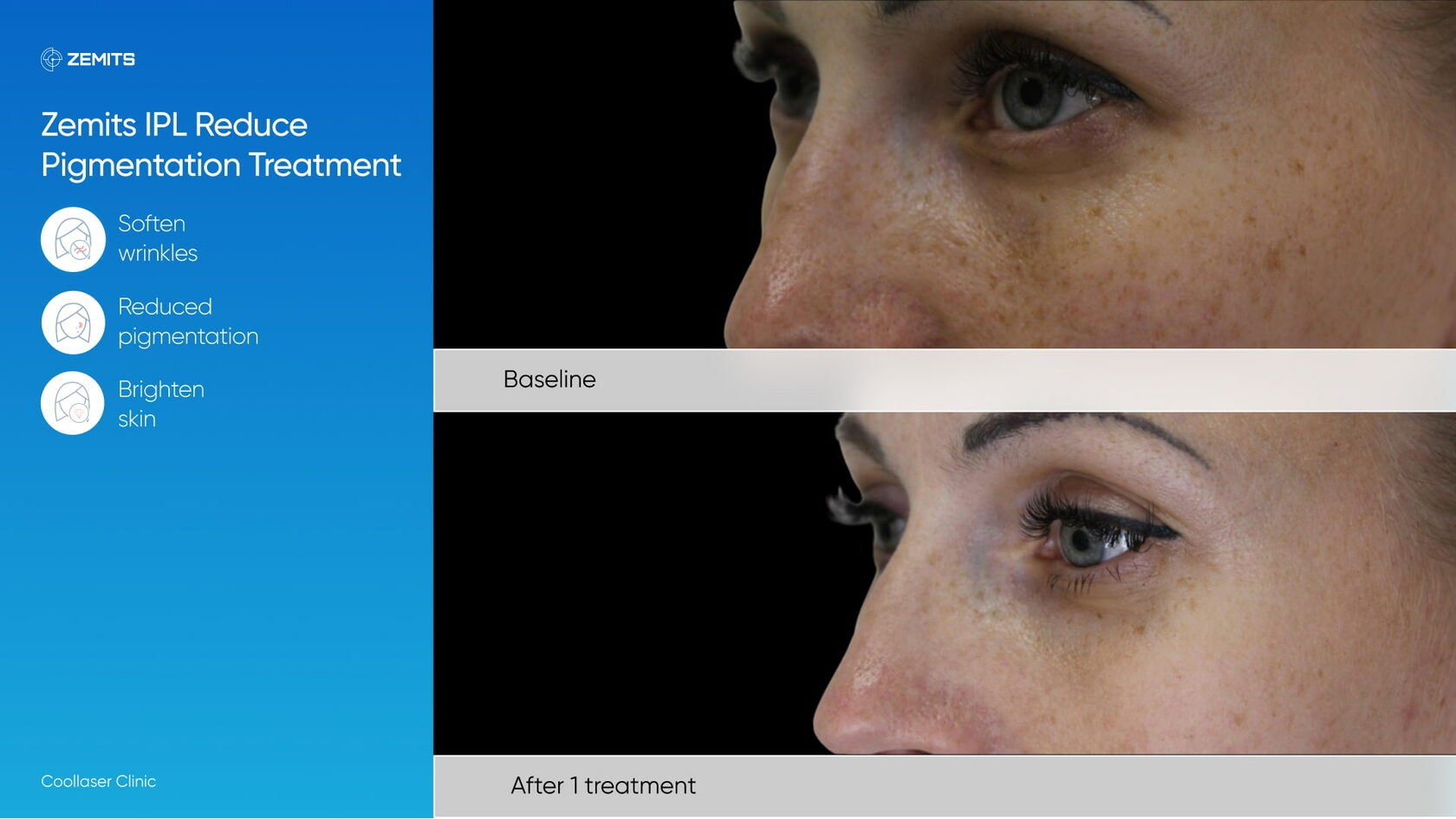 Zemits_real_results_1402.jpg My default image