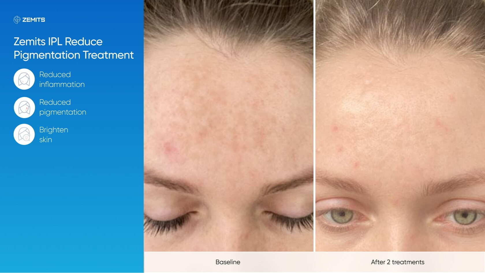 Zemits_real_results_1405.jpg My default image