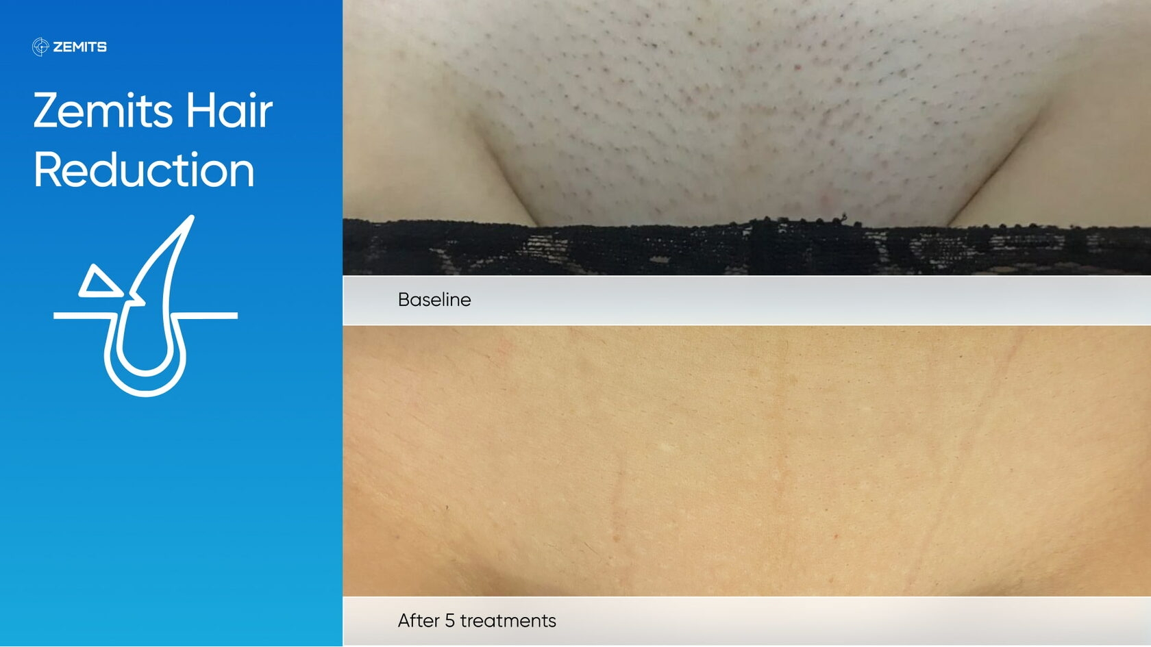 Zemits_real_results_1501.jpg My default image