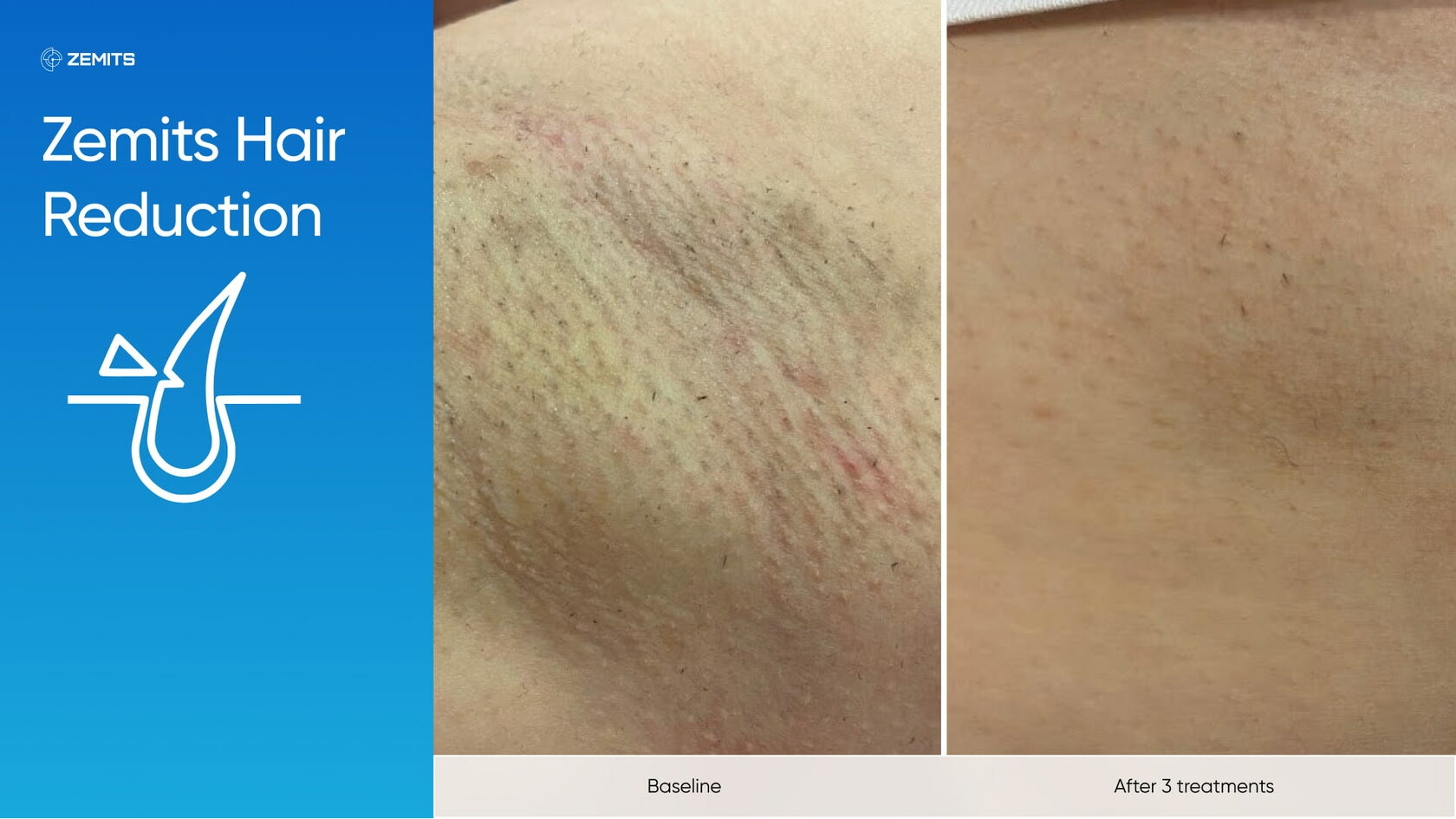 Zemits_real_results_1502.jpg My default image