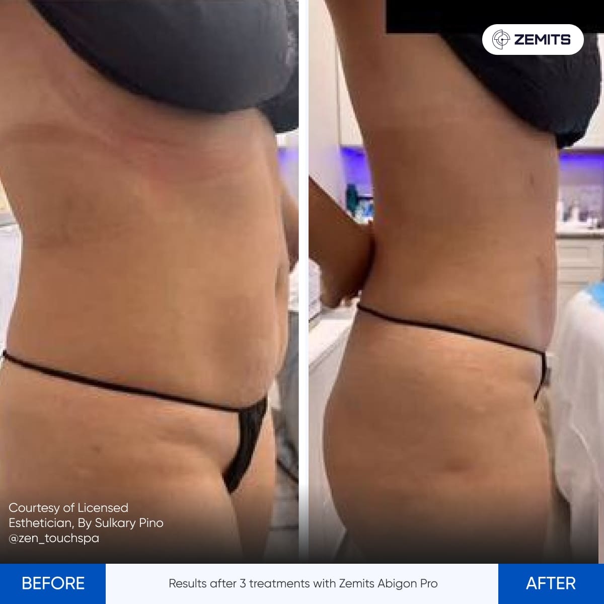 Results after 3 treatments with Zemits Abigon Pro.jpg My default image