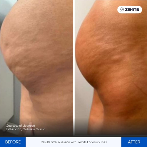 Results after 6 session with Zemits EndoLuxx PRO.jpg My default image