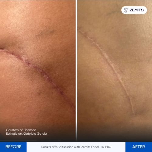 Results after 20 session with Zemits EndoLuxx PRO.jpg My default image