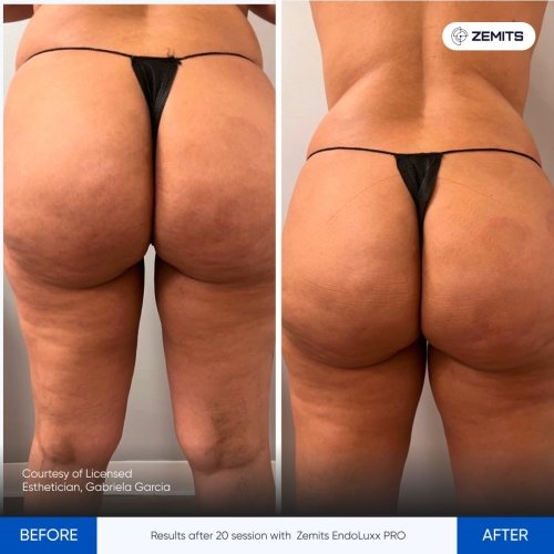 Results after 20 session with Zemits EndoLuxx PRO 2.jpg My default image