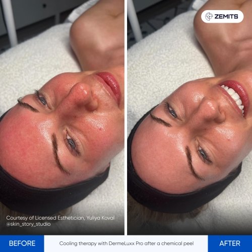 Cooling therapy with DermeLuxx Pro after a chemical peel.jpg My default image