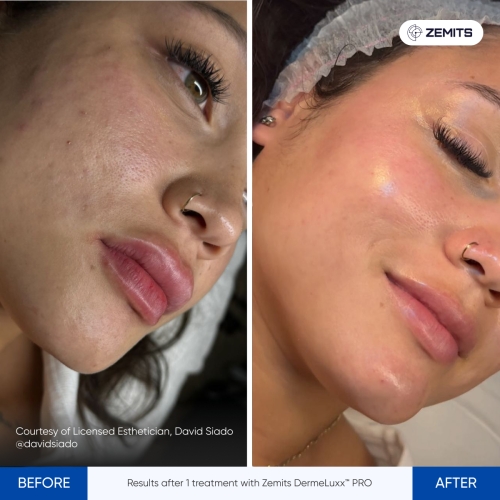 Results after 1 treatment with Zemits DermeLuxx™ PRO.jpg My default image
