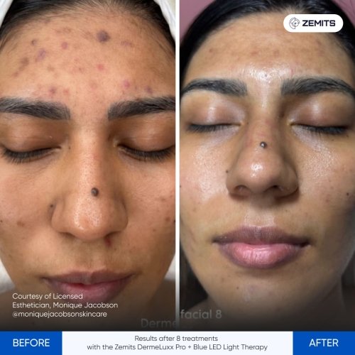 Results after 8 treatments with the Zemits DermeLuxx Pro + Blue LED Light Therapy.jpg My default image