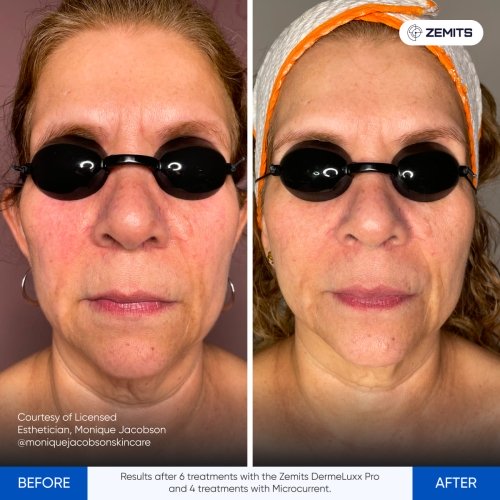 Results after 6 treatments with the Zemits DermeLuxx Pro and 4 treatments with Microcurrent..jpg My default image