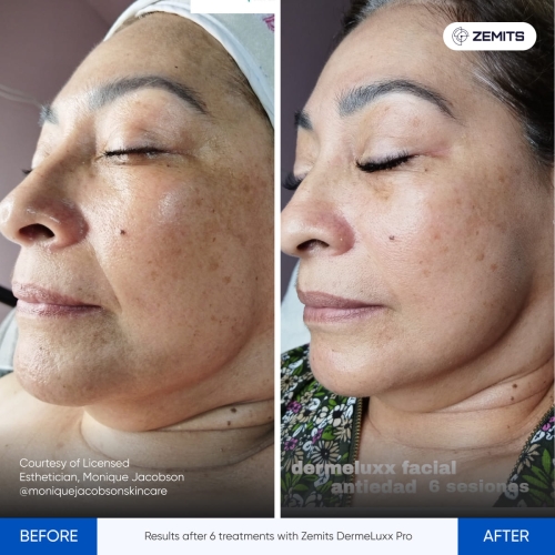 Results after 6 treatments with Zemits DermeLuxx Pro.jpg My default image