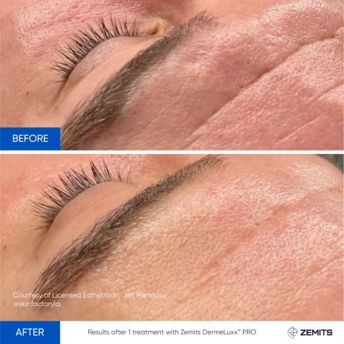 Results after 1 treatment with Zemits DermeLuxx™ PRO 14.jpg My default image