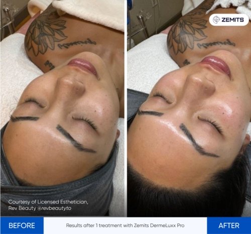 21.Acne and Inflammation.jpg My default image