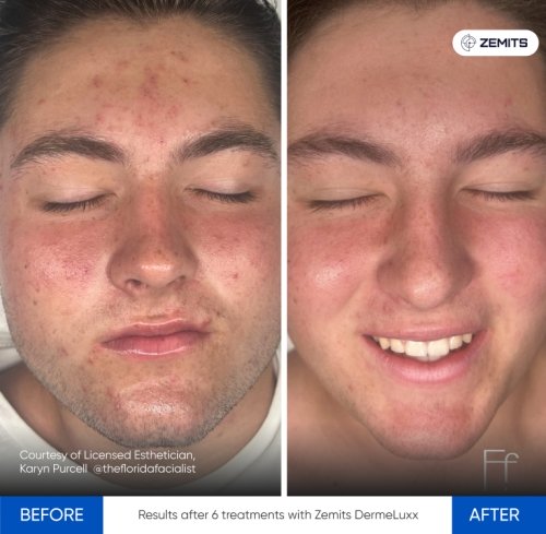 Results after 6 treatments with Zemits DermeLuxx.jpg My default image