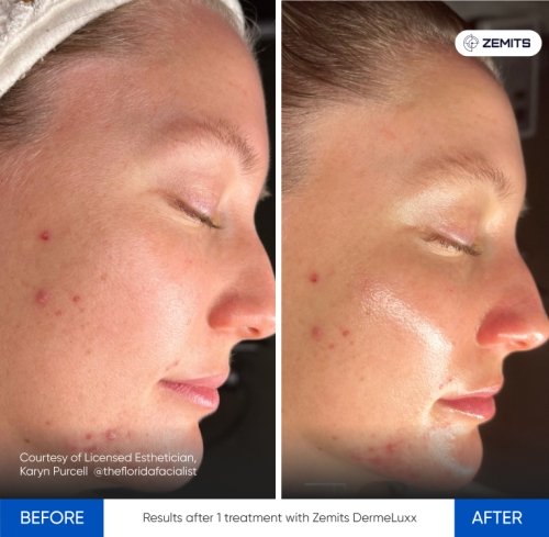 Results after 1 treatment with Zemits DermeLuxx.jpg My default image