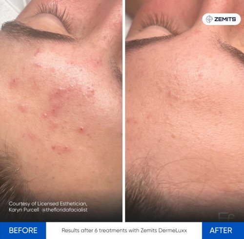 Results after 6 treatments with Zemits DermeLuxx 2.jpg My default image