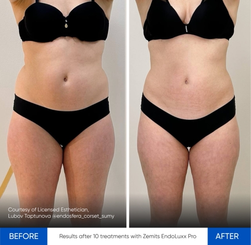 Zemits EndoLuxx Pro 3.jpg My default image