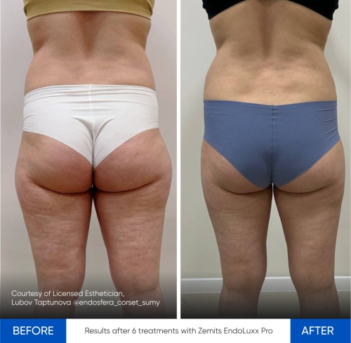 Zemits EndoLuxx Pro 5.jpg My default image