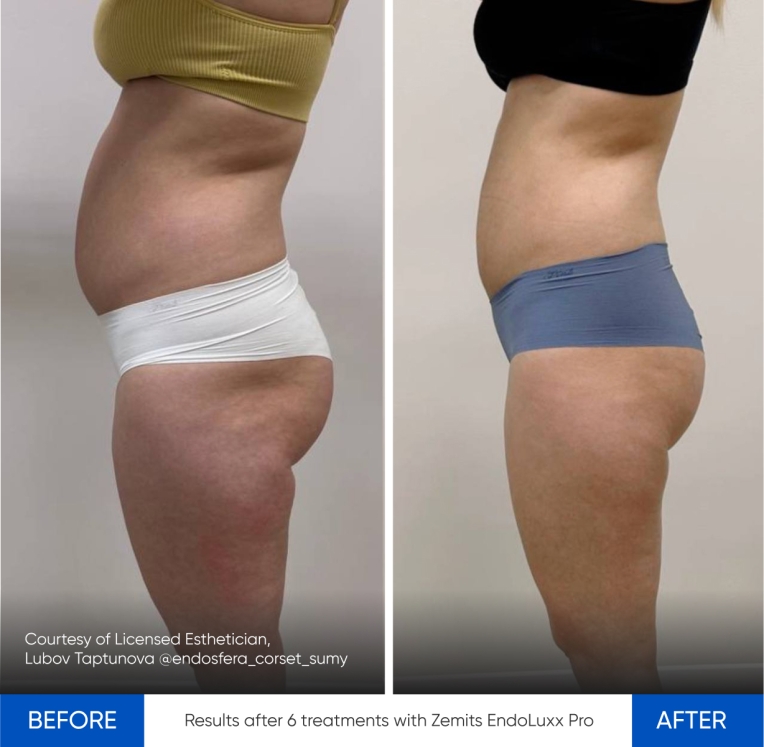 Zemits EndoLuxx Pro 6.jpg My default image