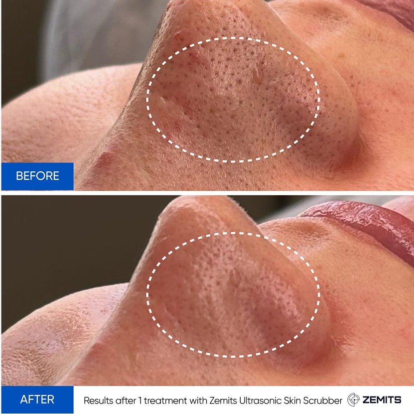 Results after 1 treatment with Zemits Ultrasonic Skin Scrubber.jpg My default image