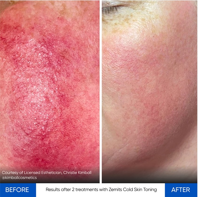 Results after 2 treatments with Zemits Cold Skin Toning.jpg My default image