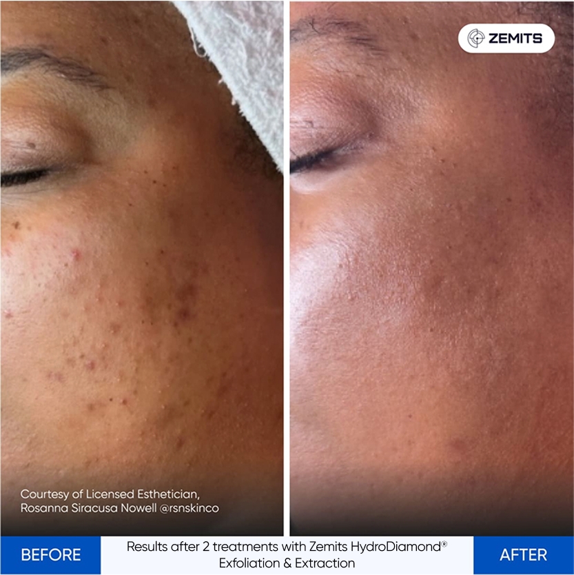 Results after 2 treatments with Zemits HydroDiamond® Exfoliation & Extraction-1.jpg My default image