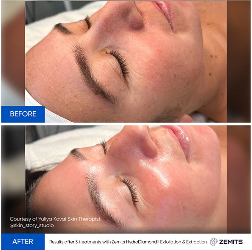 Results after 3 treatments with Zemits HydroDiamond® Exfoliation & Extraction-1.jpg My default image