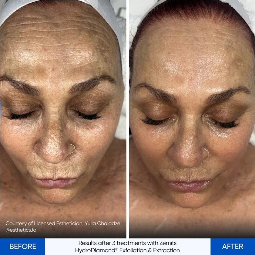 Results after 3 treatments with Zemits HydroDiamond® Exfoliation & Extraction.jpg My default image
